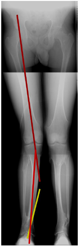 Minimally invasive distal tibial osteotomy and correction of deformity with  the Taylor Spatial Frame – Orthoracle LuanMD