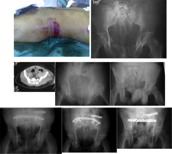 Open Pelvic Fractures Review of 30 Cases