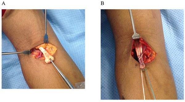 Distal Biceps and Triceps Injuries