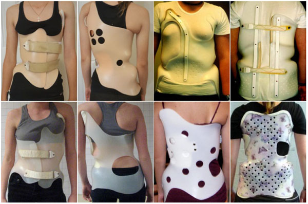 The Wilmington brace is a popular thoracolumbosacral orthosis that is