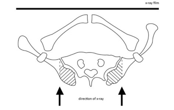 PDF) Rib Cage Measurement Reproducibility Using 3D Stereoradiographic  Reconstruction in Preoperative Adolescent Idiopathic Scoliosis