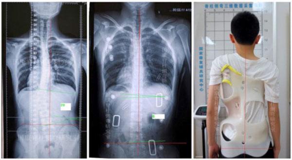 The Role of Correction in the Conservative Treatment of Adolescent  Idiopathic Scoliosis
