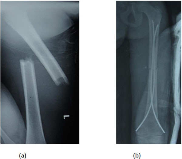 Fracture Femur- Antegrade Rodding – Dr. Nabil Ebraheim's Blog