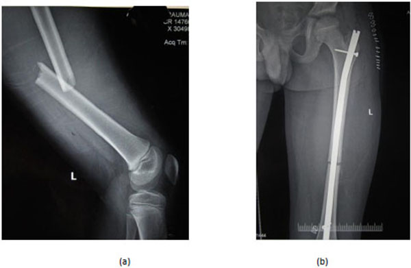 Intramedullary Arthrodesis of the Knee in the Treatment of Sepsis after TKR  - Carl T. Talmo, James V. Bono, Mark P. Figgie, Thomas P. Sculco, Richard  S. Laskin, Russell E. Windsor, 2007