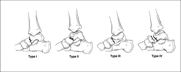 types of talus fractures