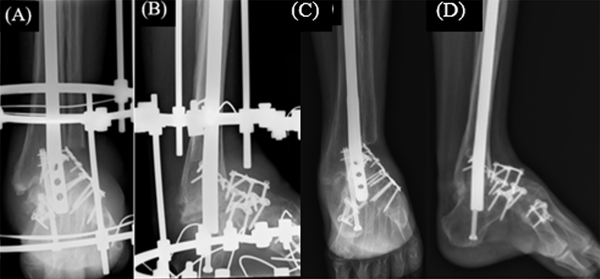 x ray hindfoot fusion