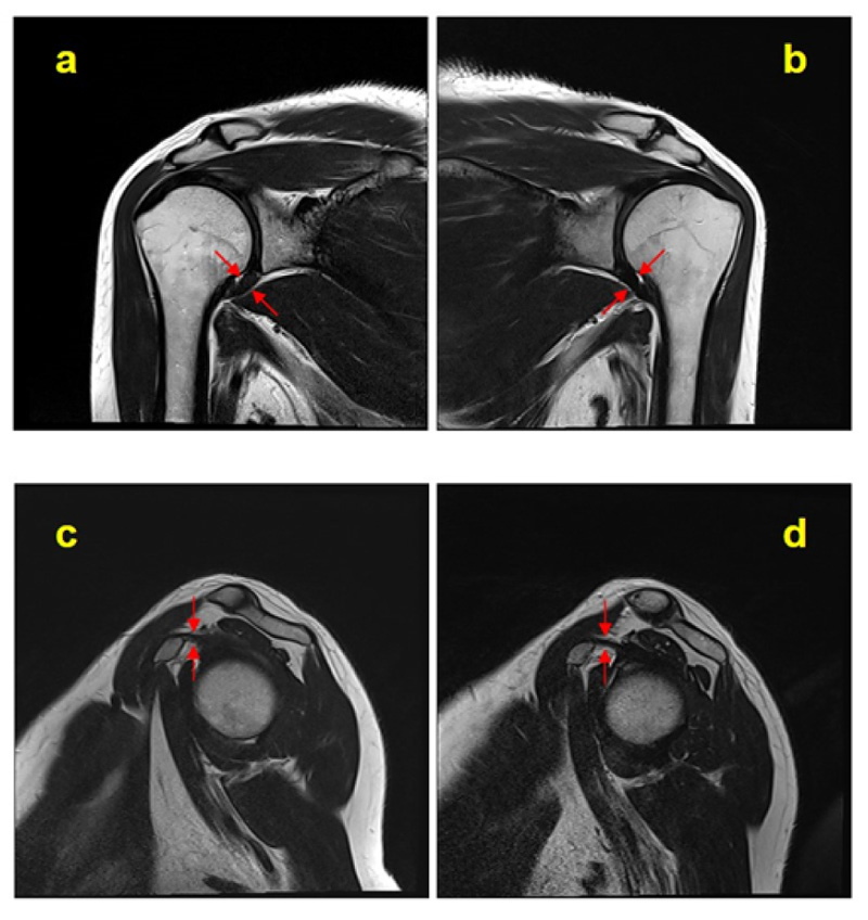 Typical magnetic resonance imaging scan showing the coracohumeral