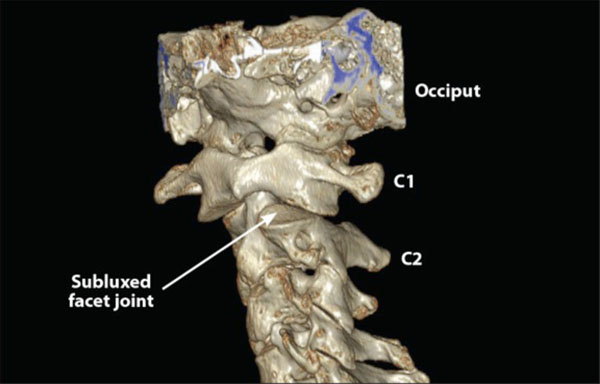 cervical instability