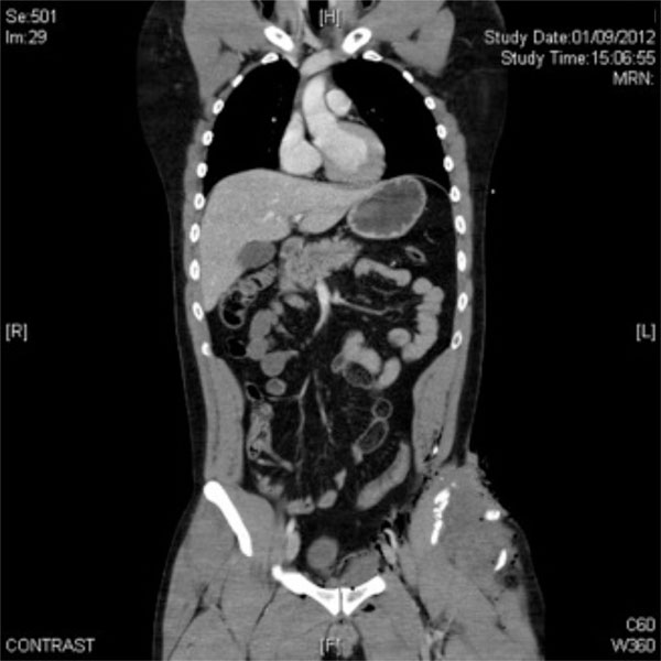 Osteochondroma-Related Pressure Erosions in Bony Rings Below the Waist