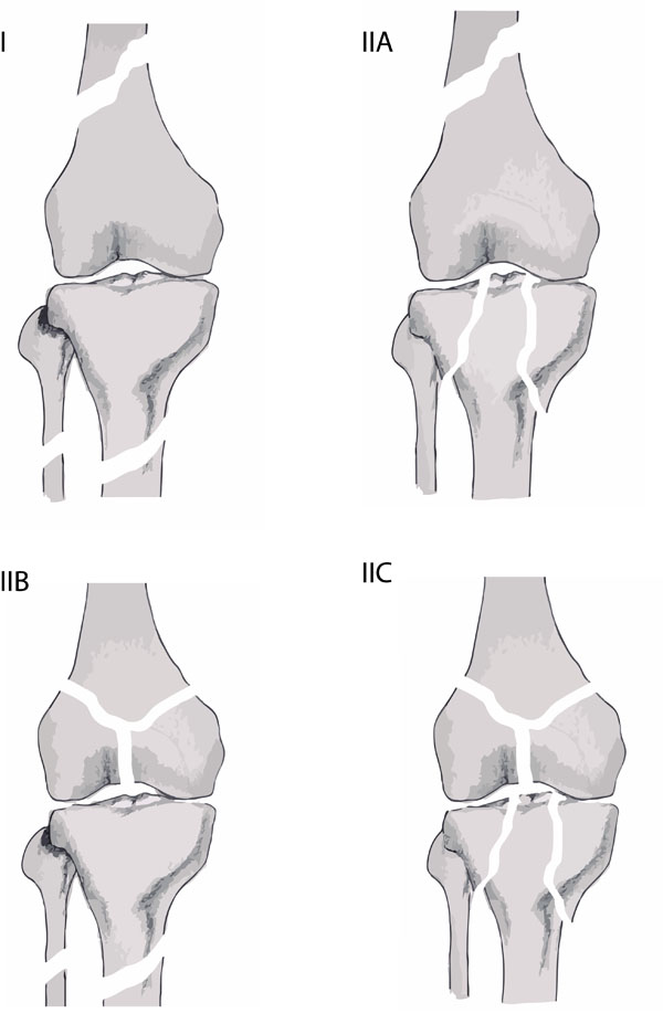 Osteochondroma-Related Pressure Erosions in Bony Rings Below the Waist