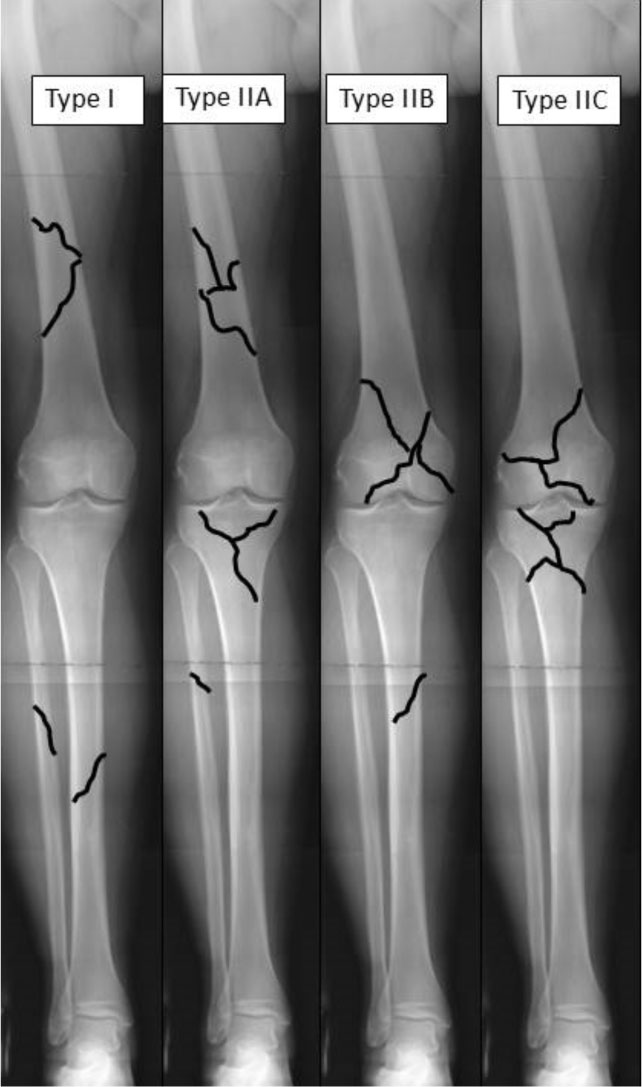 Osteochondroma-Related Pressure Erosions in Bony Rings Below the Waist