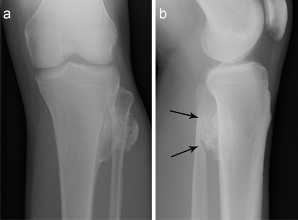 osteoartrita deformatoare a genunchiului artrita osoasa